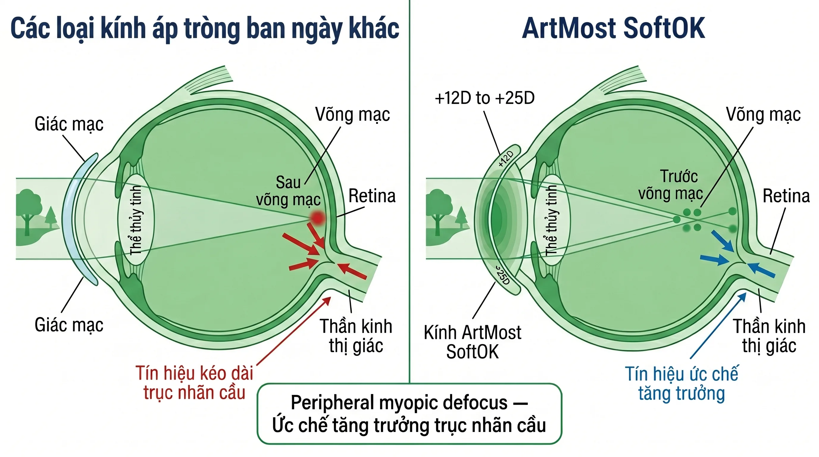 ArtMost® SoftOK® — Peripheral myopic defocus so với kính thông thường