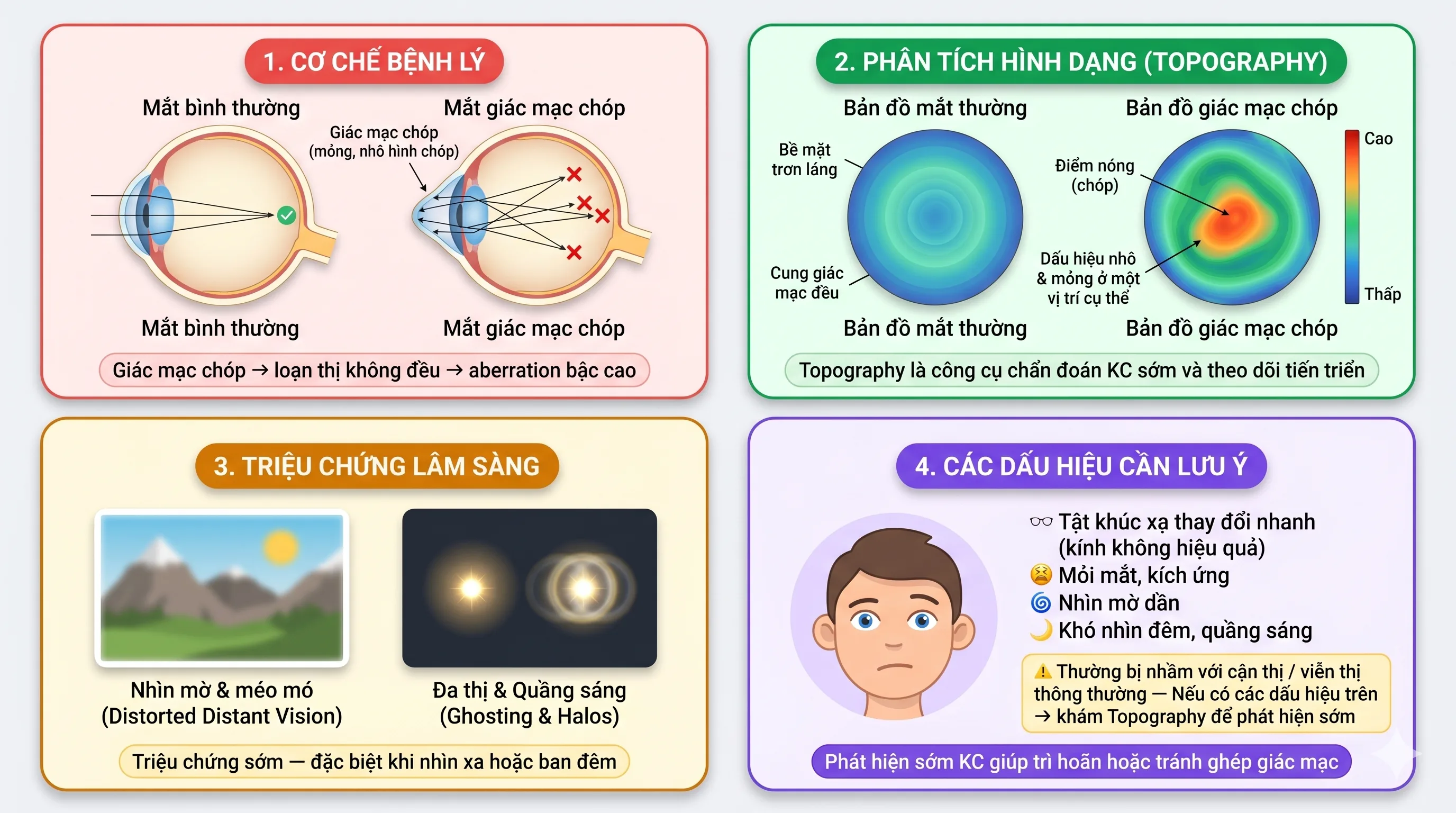 Giác mạc chóp Keratoconus: cơ chế bệnh lý, topography, triệu chứng, dấu hiệu nhận biết