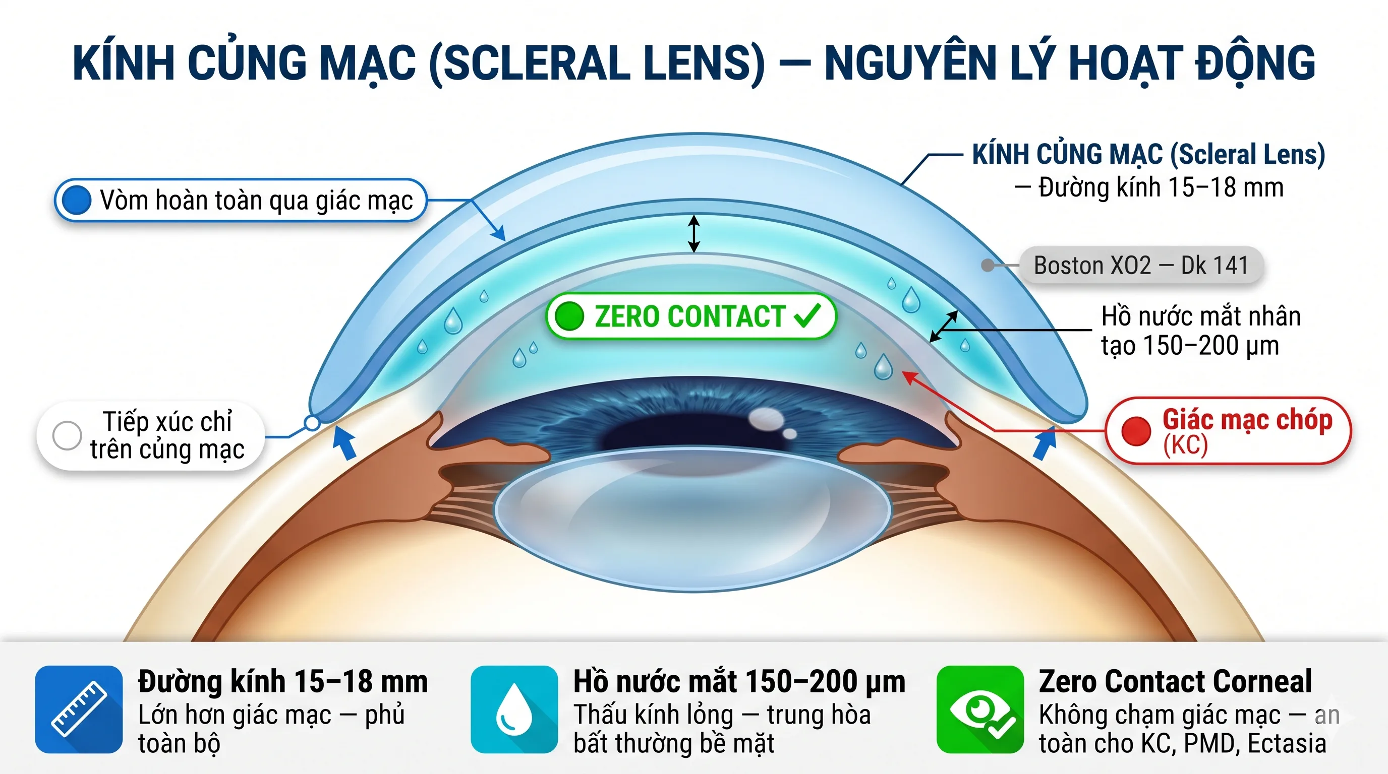 So sánh kính RGP giác mạc thông thường và kính củng mạc GOV® Scleral