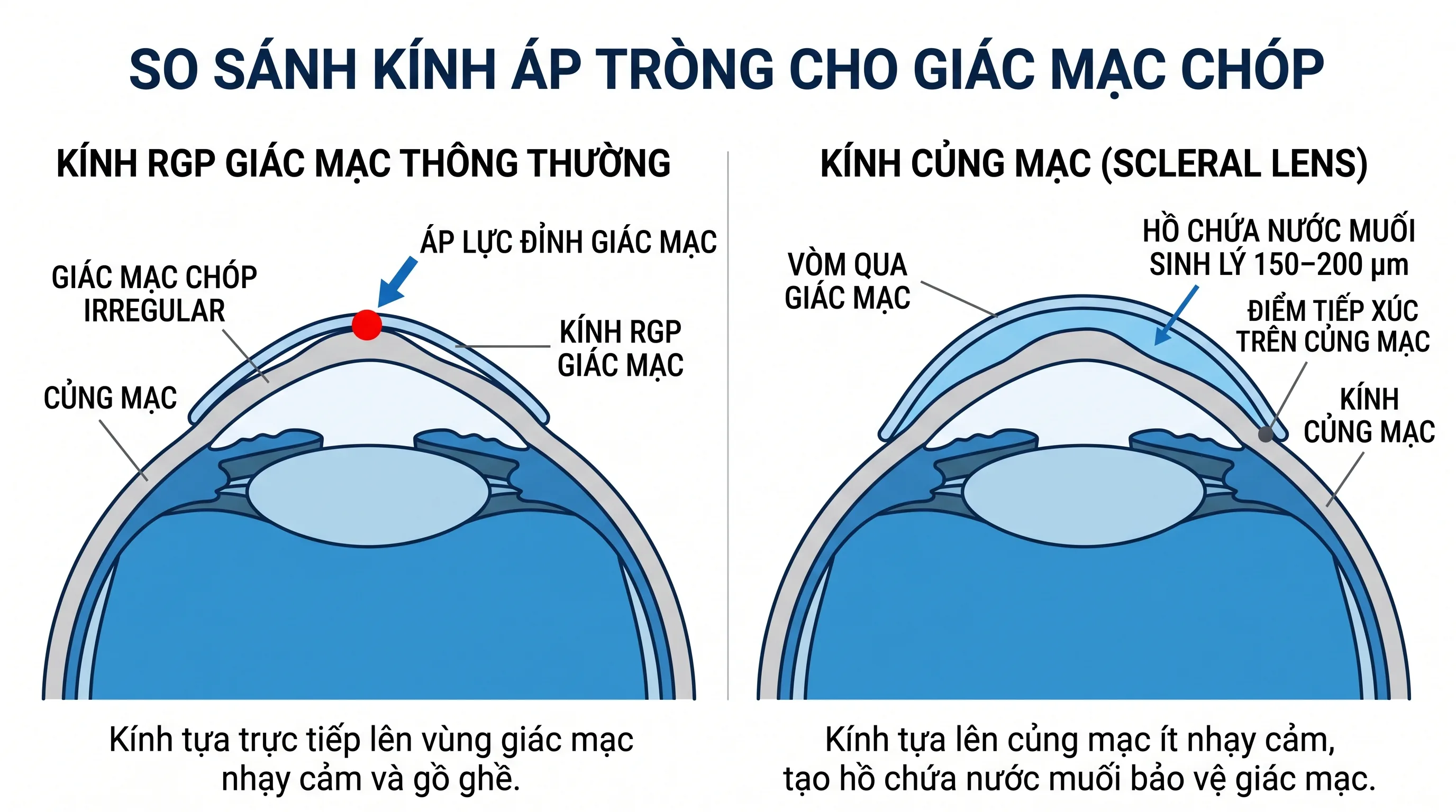 Kính củng mạc GOV® Scleral — so sánh RGP giác mạc và kính củng mạc