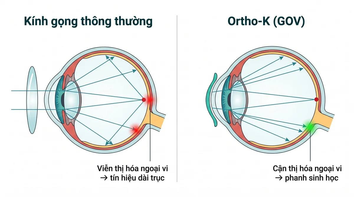 Ortho-K kiểm soát cận thị