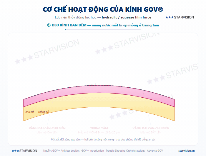 Chu kỳ tái định hình biểu mô giác mạc của kính GOV XMJ: đeo kính ban đêm biểu mô trung tâm mỏng đi và vành đai cận-chu biên dày lên, sáng tháo kính vẫn giữ hình cả ngày, ngừng đeo hẳn khoảng hai tuần thì giác mạc trở về bình thường