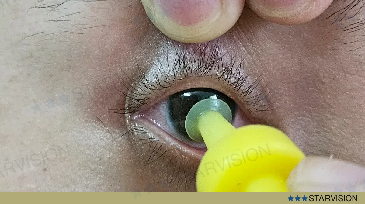 Ảnh chụp thật: một tay giữ mi trên, tay kia dùng dụng cụ plunger đưa kính Ortho-K lên giác mạc